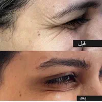 آف چربی بوتاکس ساکشن غبغب ژل مزو PRP، پزشک مجرب|خدمات آرایشگری و زیبایی|زاهدان, |دیوار