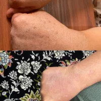 ابرسانی عمیق پوست به صورت تزریقی فقط ۱۴۰۰|خدمات آرایشگری و زیبایی|یاسوج, |دیوار