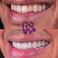 کامپوزیت دندان لبه شیشه ای فکی ۱۰ با اقساط بلندمدت|خدمات آرایشگری و زیبایی|تهران, تجریش|دیوار