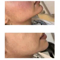 تزریق فیلر، بوتاکس،  مادلینگ زیر نظر متخصص|خدمات آرایشگری و زیبایی|کرمانشاه, |دیوار
