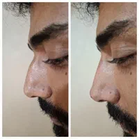 مطب پزشک ژل لب گونه چونه زاویه فک بوتاکس فیلر بینی|خدمات آرایشگری و زیبایی|قم, صفائیه|دیوار