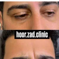 جشنواره ی پاییزه ی فیلر وبوتاکس|خدمات آرایشگری و زیبایی|ارومیه, |دیوار