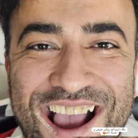 ایمپلنت کاشت دندان لمینت کامپوزیت ایمپلنت ۶۵۰۰|خدمات آرایشگری و زیبایی|تهران, ستارخان|دیوار