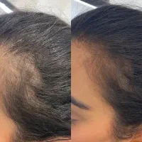 خدافظی با ریزش مو|آرایشی، بهداشتی، درمانی|شهریار, رزکان|دیوار