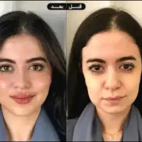 مرکز تخصصی جوانسازی اندولیفت/هایفو/لیفت فقط۸۹۰ت|خدمات آرایشگری و زیبایی|اصفهان, لاله|دیوار