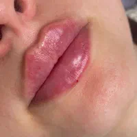 تزریق ژل بوتاکس ساکشن غبغب نخ لیفت توسط پزشک|خدمات آرایشگری و زیبایی|کرج, گلشهر|دیوار