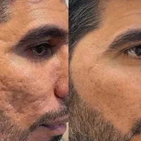 انجام کلیه خدمات پاکسازی پوست بصورت کاملا تخصصی|خدمات آرایشگری و زیبایی|سرپل ذهاب, |دیوار