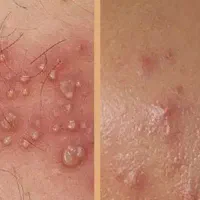 کنترل تبخال تناسلی بصورت تخصصی