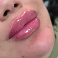 ژل بوتاکس 600