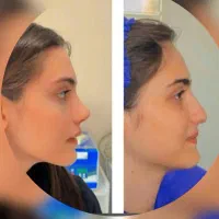 عمل زیبایی بینی 24میلیون|خدمات آرایشگری و زیبایی|قائم‌شهر, |دیوار