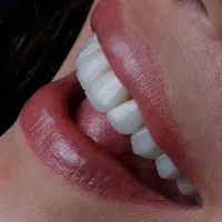 کامپوزیت لمینت بلیچینگ تخصصی|خدمات زیبایی و سلامت|شیراز, ستارخان|دیوار