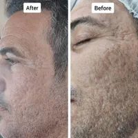فیشیال و درمان عارضه های پوستی|خدمات آرایشگری و زیبایی|اصفهان, محله اسلامی|دیوار