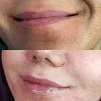 انواع خدمات ژل بوتاکس انزیم تخفیف ویژه|خدمات آرایشگری و زیبایی|کوهدشت, |دیوار