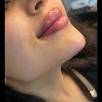 جشنواره ژل و بوتاکس