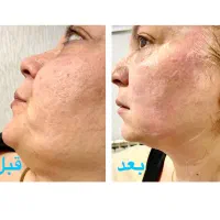 تخفیف استثنایی هایفوصورت،واژینال،کک،مک،درمان تیرگی|خدمات آرایشگری و زیبایی|تهران, هاشمی|دیوار