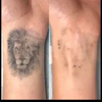 ریموتتو ابرو و بدن با پیشرفته ترین دستگاه تضمینی|خدمات آرایشگری و زیبایی|اهواز, کیانپارس |دیوار