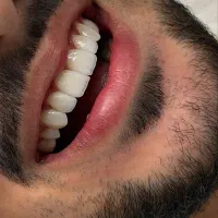 اقساط ۶۰ ماهه کامپوزیت/ لمینت/ایمپلنت ، دندانپزشکی|خدمات زیبایی و سلامت|تبریز, |دیوار