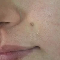 برداشتن انواع خال گوشتی و زگیل ومیکرونیدلینگ|خدمات آرایشگری و زیبایی|قم, انصار‌الحسین|دیوار