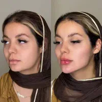 تزریق ژل لب عیدانه ۴۹۹