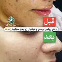فیشیال تخصصی پوست،همراه اشانتیون ویژه|خدمات آرایشگری و زیبایی|اصفهان, شهریار|دیوار