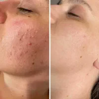 فیشال و پاکسازی پوست ( اینو قبل از هر درمانی بخون)