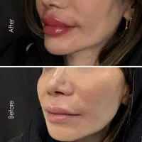 تخفیف ویژه فیلر لب و کانتورینگ|خدمات آرایشگری و زیبایی|کرج, کوی زنبق|دیوار