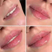 فیلر لب ۶۳۰ تخفیف