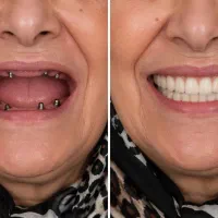 کاشت دندان با روکش رایگان ( ایمپلنت دندان )