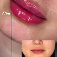 تزریق ژل لب و بوتاکس|خدمات آرایشگری و زیبایی|تهران, خزانه|دیوار