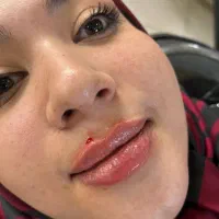 ژل و بوتاکس|خدمات آرایشگری و زیبایی|مشهد, ایثار|دیوار