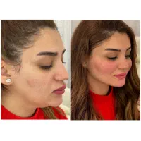 تزریق تخصصی فیلروبوتاکس و آنزیم توسط پزشک|خدمات آرایشگری و زیبایی|کرمانشاه, |دیوار