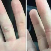 خال گوشتی نواحی خصوصی