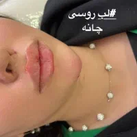 ژل و بوتاکس 70% تخفیف