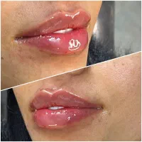 تزریق ژل و بوتاکس و مزوتراپی/ژل لب M تکنیک|خدمات آرایشگری و زیبایی|مشهد, نیروی هوایی|دیوار