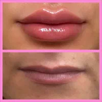 تزریق ژل،بوتاکس ولیزر موهای زائد