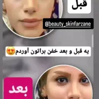 تپلی صورت|آرایشی، بهداشتی، درمانی|رشت, بلوار گیلان|دیوار