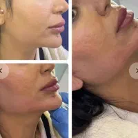 چشنواره مخصوص عیدانه فیلر و بوتاکس