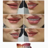 دندان مصنوعی تبریز