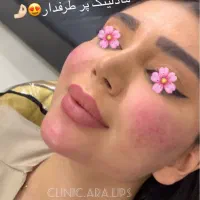 ژل/بوتاکس/مزو ژل/وآموزش