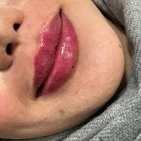 تزریق فیلر توسط پزشک برند رووفیل ۶۹۸ تومان|خدمات آرایشگری و زیبایی|خرم‌آباد, |دیوار