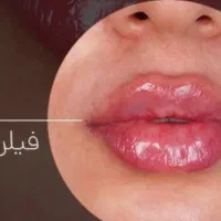 تخفیف ویژه تزریق فیلر