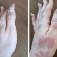 اگزما-پیسی-پسوریازیس