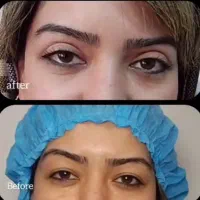 تخفیف عالی عمل زیبایی پلک بالا و پایین برای عید