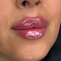 تخفیفات تزریق ژل و بوتاکس تخصصی درکلینیک توسط پزشک|خدمات زیبایی و سلامت|کرج, گوهردشت|دیوار