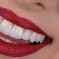 مهمترین عنصر زیبایی صورت ظاهر دندانهاست|خدمات آرایشگری و زیبایی|عنبرآباد, |دیوار