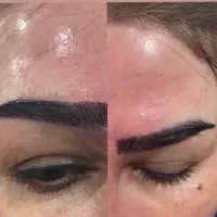 ژل بوتاکس اقساط