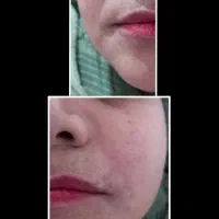 تزریق ژل بوتاکس آنزیم مزو ، خدمات پیرسینگ پرسینگ در صدرا-فارس، فاز ۱