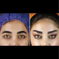 جشنواره تخفیف جراحی زیبایی شقیقه،بلفارو،دایرکت|خدمات آرایشگری و زیبایی|پرند, فاز ۲|دیوار