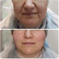 جشنواره تخفیف پی آر پی و ژل و بوتاکس|خدمات آرایشگری و زیبایی|شیراز, زرگری|دیوار