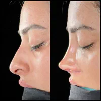عمل بینی با پیش پرداخت ۱۰ میلیون و اقساط ۶ ماهه